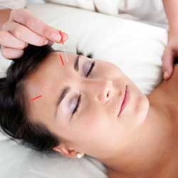 Cosmetic Acupuncture