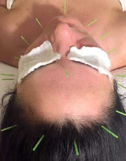 TREATMENTS_CosmeticAcupuncture_FacialRejuvenation_B - Copy.jpg