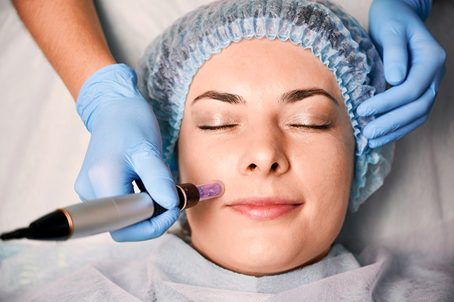 TREATMENTS_Microneedling_Large.jpg